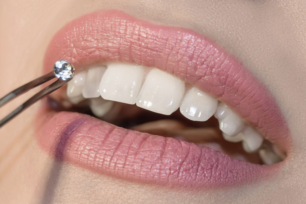 Teeth gems at Perth City Dental