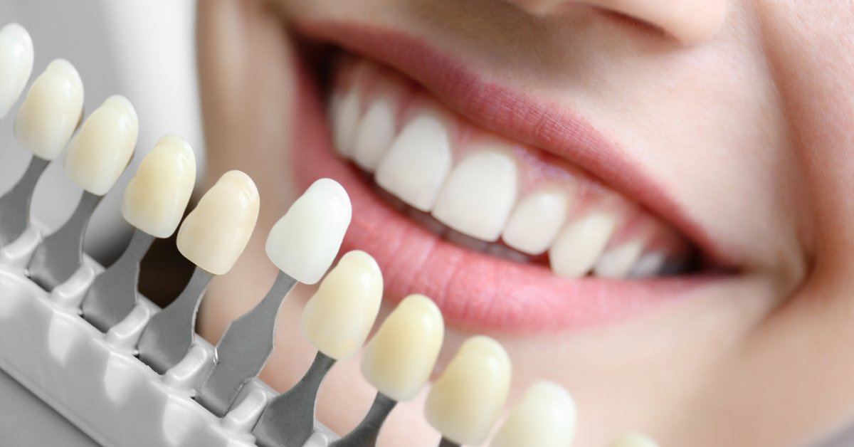 Woman's smile with white teeth. Shade guide for teeth whitening. Expert tips for a brighter smile and maintaining white teeth.