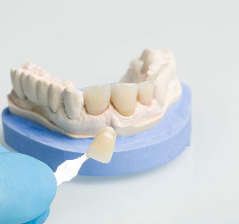 Dental veneers at Perth dentist. Shade matching for porcelain veneers on a tooth model. Are veneers worth it?