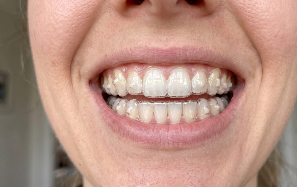 invisalign perth