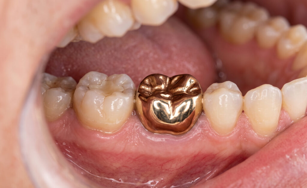 metal crown